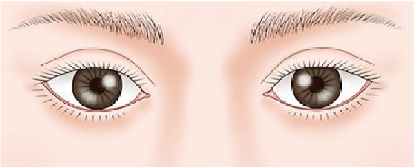 二重修正術 前の目元イラスト